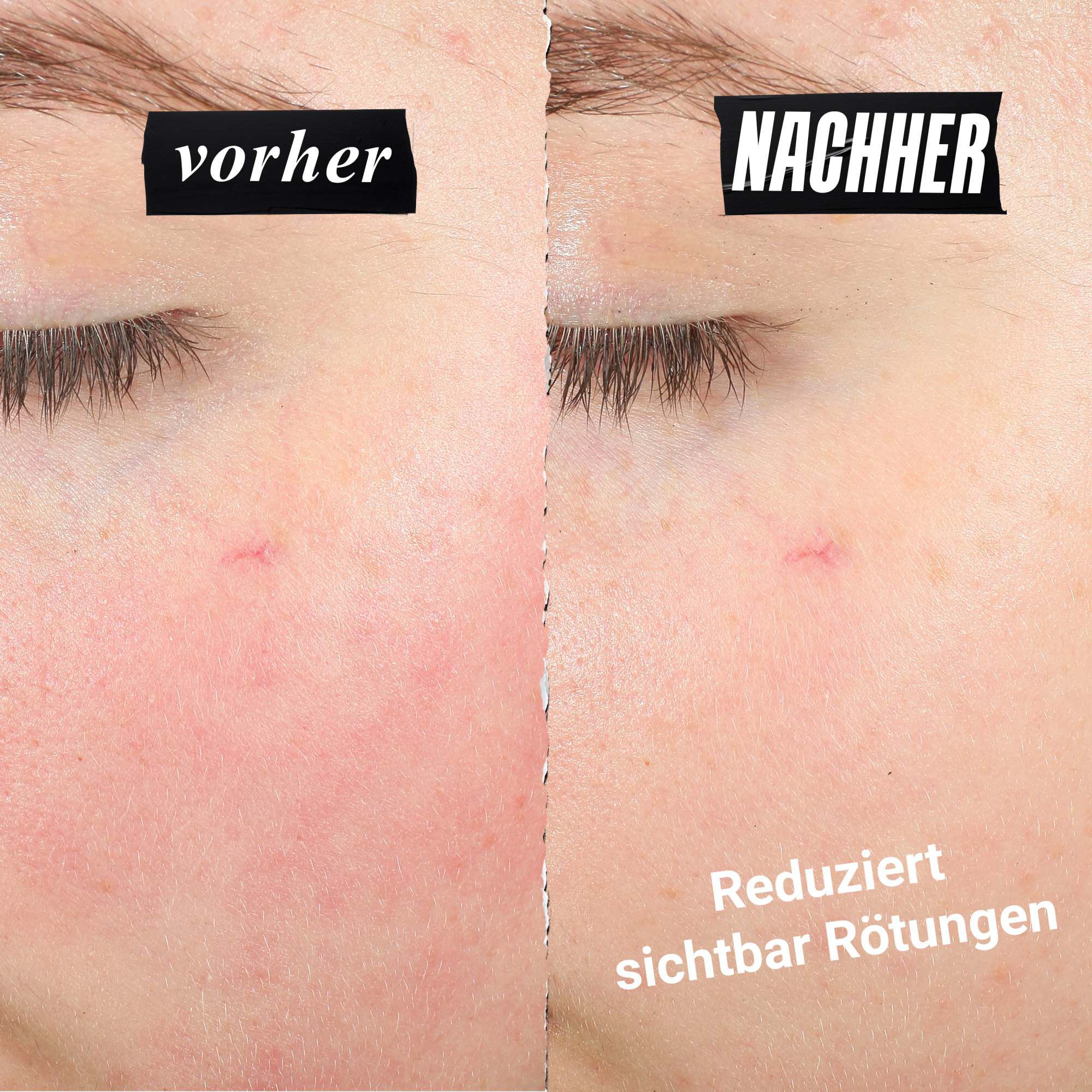 Vergleich, der eine reduzierte Hautrotung zeigt. Text: Reduziert Rotungen sichtbar.