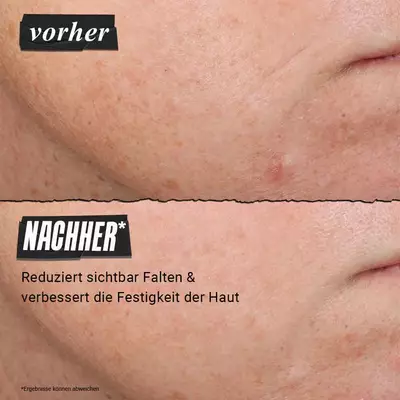 Vorher-Nachher-Bild: Nahaufnahme einer weiblichen Stirn – Stirnfalten sind nach 12 Wochen Anwendung des Retinol-Serums sichtlich gemildert.