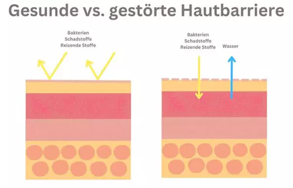 Vergleich des Aufbaus einer gesunden und einer gestorten Hautbarriere.