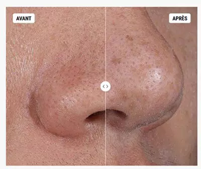 Wirkung der Rare Earth Deep Pore Cleansing Mask: Vorher-Nachher-Ergebnis